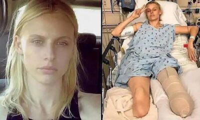 Tragedy strikes: American model loses legs and almost dies despite proper tampon use! …see more