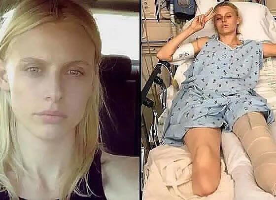 Tragedy strikes: American model loses legs and almost dies despite proper tampon use! …see more