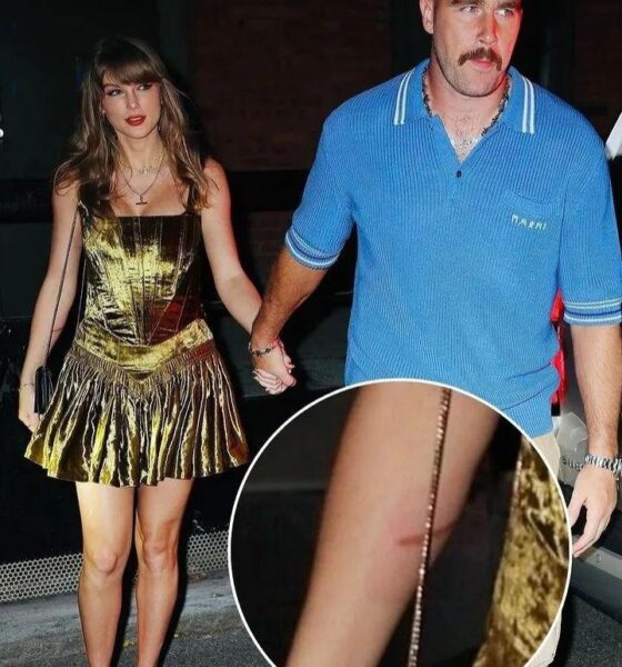 Fans have recently spotted Taylor Swift’s noticeable burn injury in photos taken with Travis Kelce…..Full details below