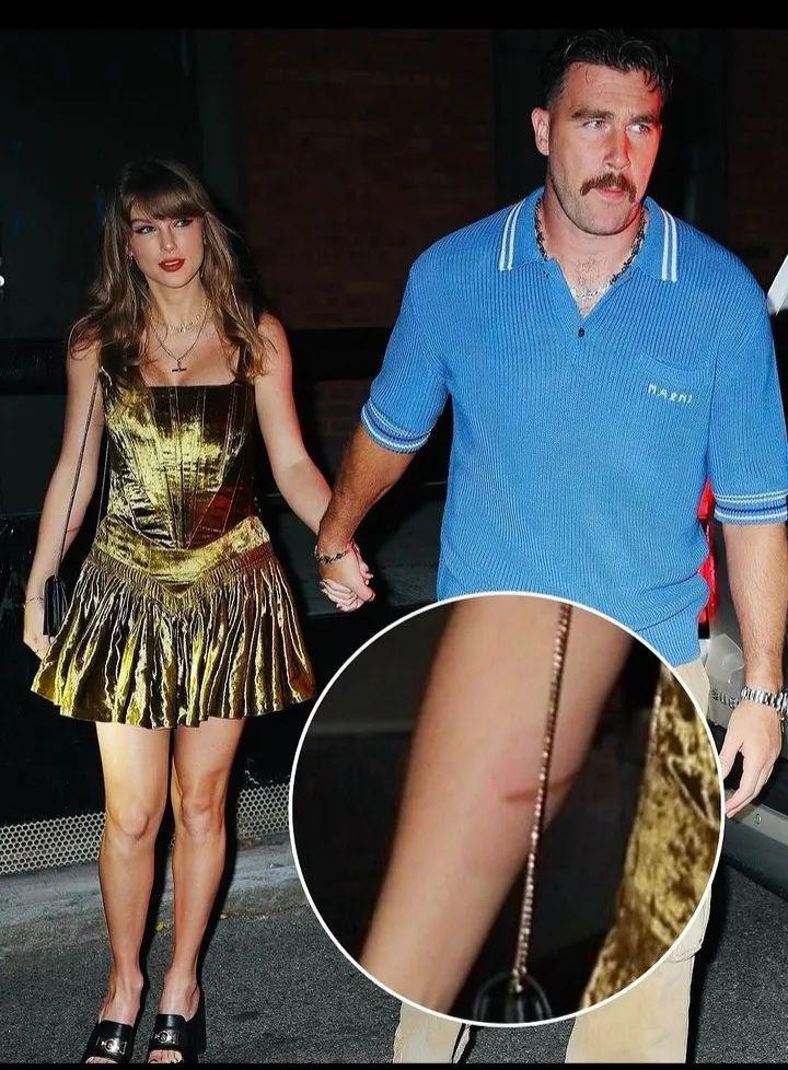 Fans have recently spotted Taylor Swift’s noticeable burn injury in photos taken with Travis Kelce…..Full details below