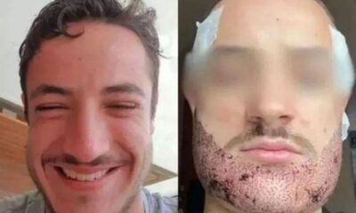 Mathieu Vigier Latour, a 24-year-old student from France, tragically ended his life after an unsuccessful beard transplant.