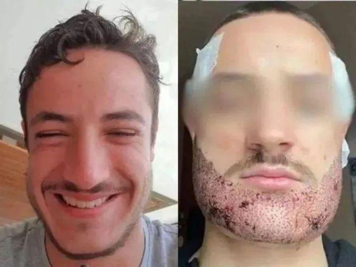 Mathieu Vigier Latour, a 24-year-old student from France, tragically ended his life after an unsuccessful beard transplant.