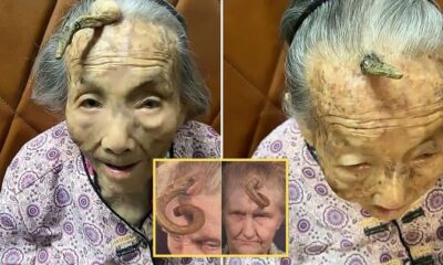 “This is too risky”: 107YO went viral because the 4-inch “Longevity Horn” growing on her forehead was said to be due to… see more