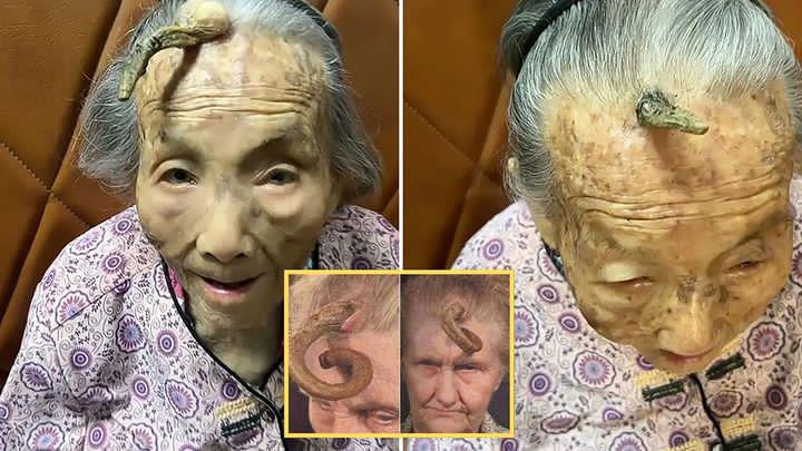 “This is too risky”: 107YO went viral because the 4-inch “Longevity Horn” growing on her forehead was said to be due to… see more