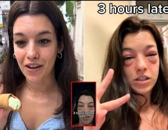 “Crazy”: Woman Ends Up In The ER With Swollen Face After Visiting Pickle-Themed Food Festival.What was in that festival that led to….see more