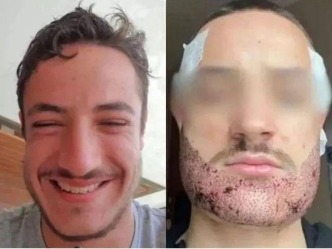 Mathieu Vigier Latour, a 24-year-old student from France, tragically ended his life after an unsuccessful beard transplant.