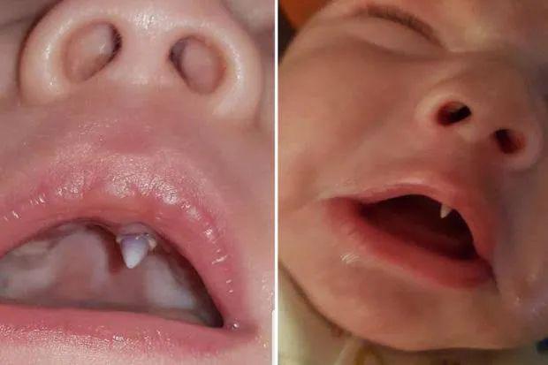 A newborn baby from County Louth, Ireland, has amazed many by growing a fang tooth overnight and.....see more detail  