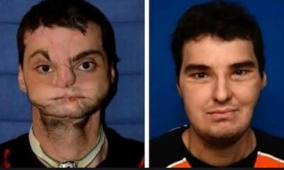 Richard Norris, who was disfigured by an accidental self-inflicted gunshot, lived reclusively for 15 years even resorting to wearing a mask to hide his own face.