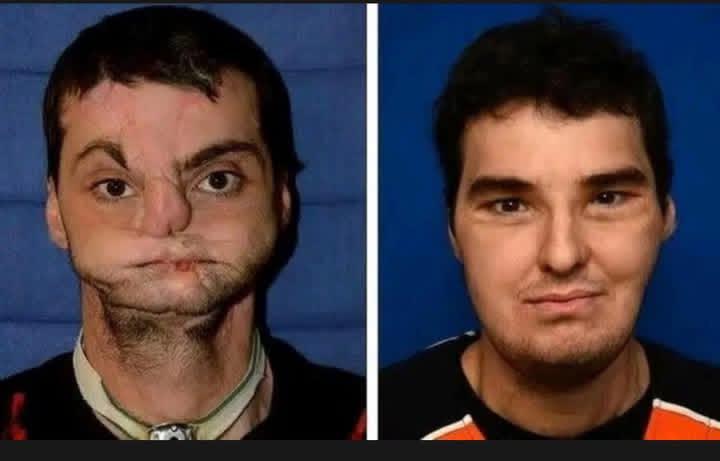 Richard Norris, who was disfigured by an accidental self-inflicted gunshot, lived reclusively for 15 years even resorting to wearing a mask to hide his own face.